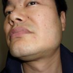 ウィルス性　イボ