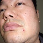 イボ取り　231114